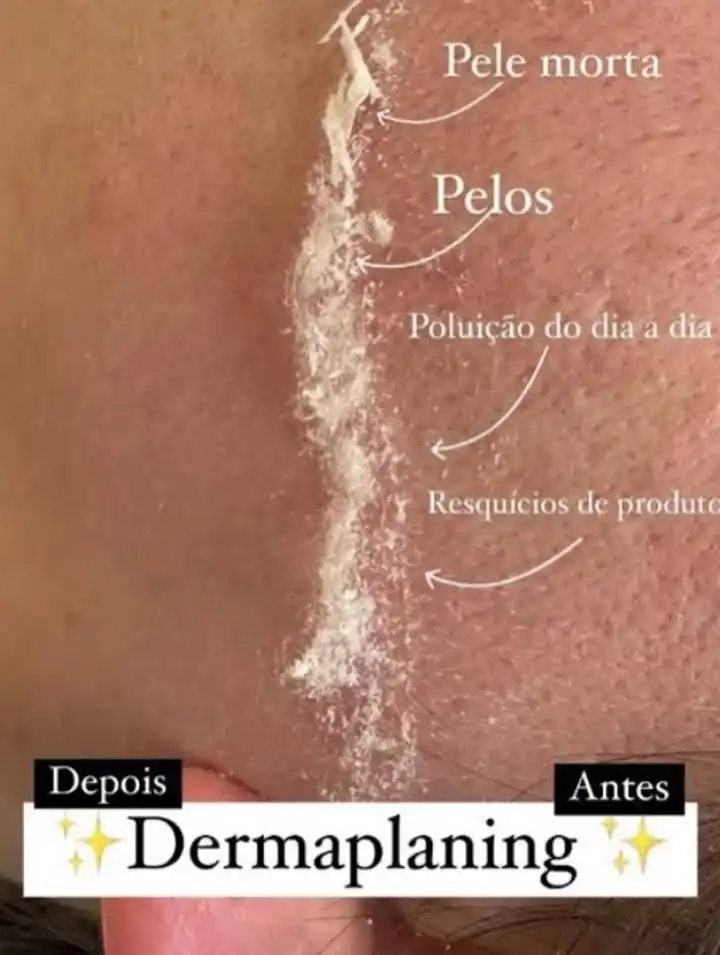Dermaplaning