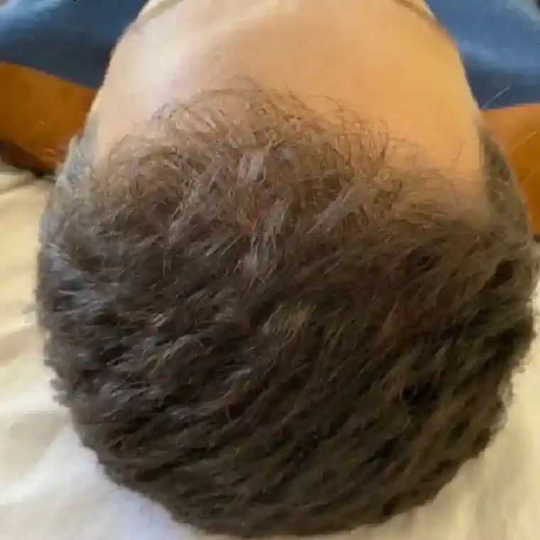 Enzimas Capilares