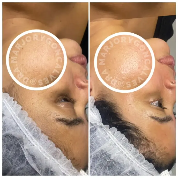 Resultado dermaplaning pele