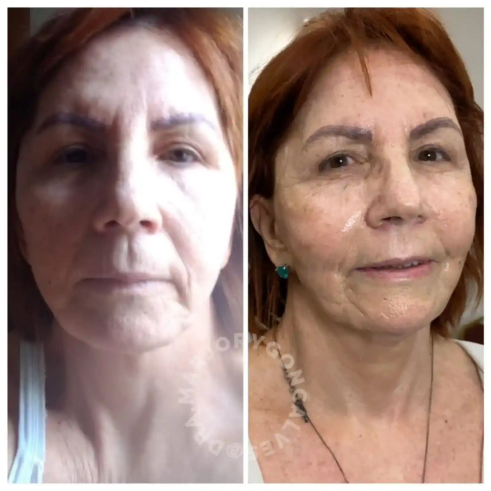 Resultado bioestimulador de colágeno facial