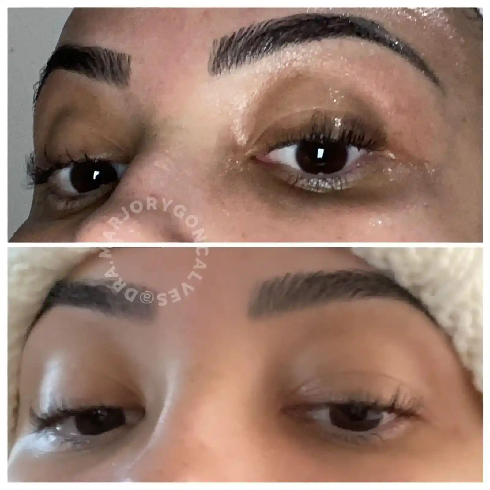 Resultado olheiras e pele antes e depois