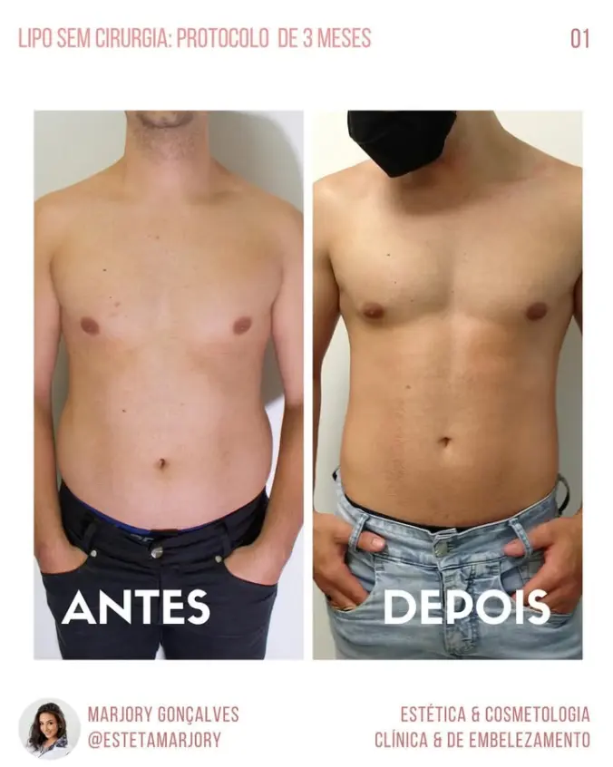 Resultado lipo sem cirurgia