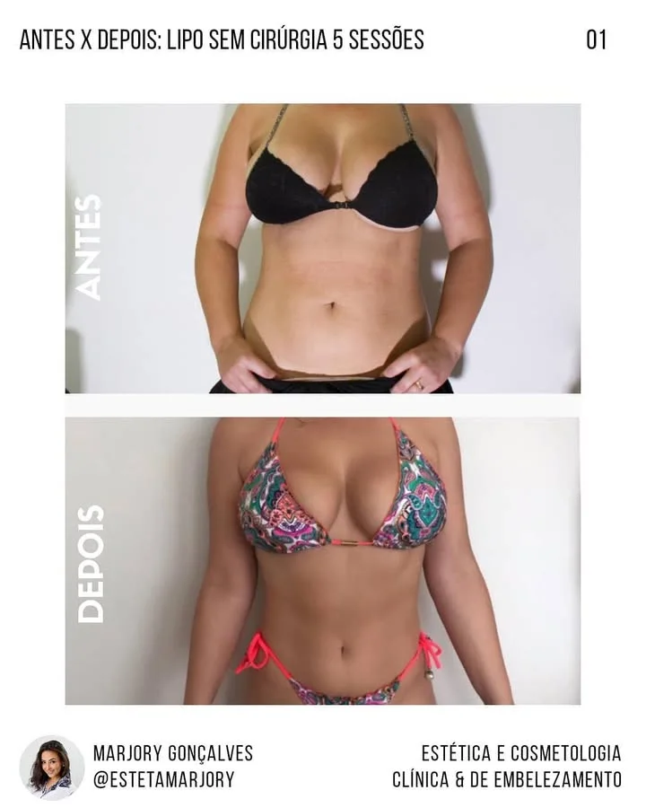 Resultado lipo sem cirurgia