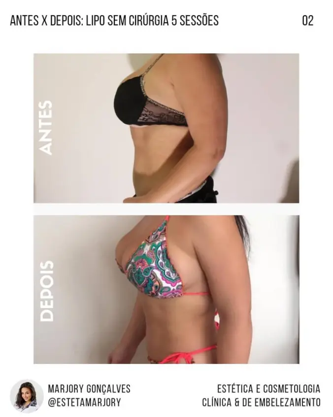 Resultado lipo sem cirurgia