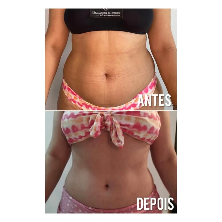 Resultado modelagem corporal