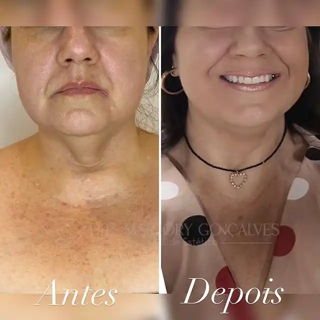 Resultado endolaser rejuvenescimento de pele